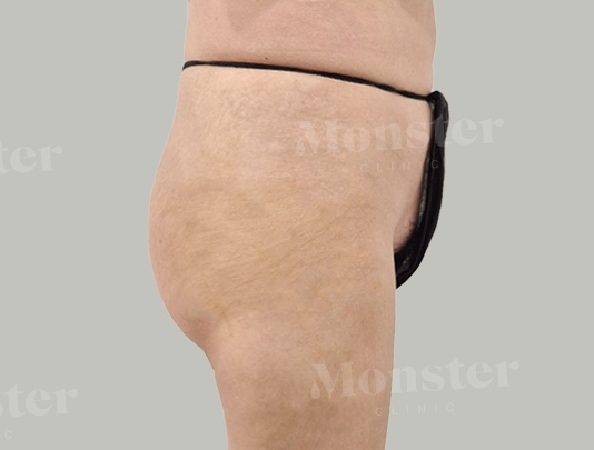 엉덩이필러 시술후 몬스터의원